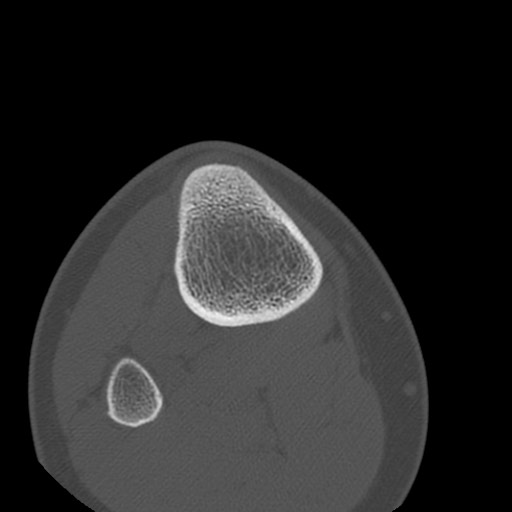 Brodie abscess of the tibia (Radiopaedia 58984-66250 Axial bone window 88).jpg