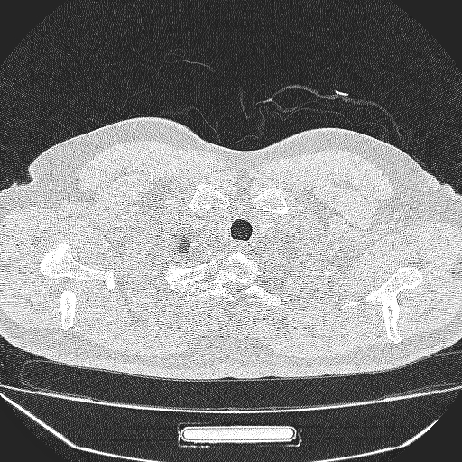 File:Bronchial atresia (Radiopaedia 58271-65417 Axial lung window 1).jpg