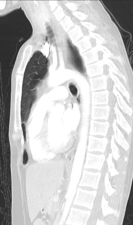 Bronchial atresia (Radiopaedia 73677-84470 Sagittal lung window 29).jpg