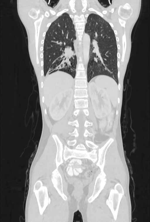 Bronchial carcinoid tumor (Radiopaedia 57187-64090 Coronal lung window 74).jpg