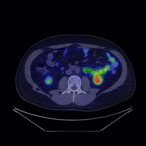 Bronchial carcinoid tumor (Radiopaedia 67377-76765 68Ga-DOTATATE PET-CT 53).jpg
