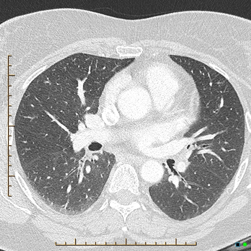 Bronchial diverticula (Radiopaedia 79512-92676 Axial lung window 95).jpg