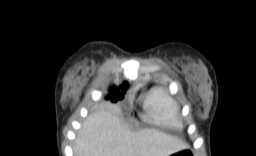 Bronchial mucoepidermoid carcinoma (Radiopaedia 57023-63895 Coronal 2).jpg