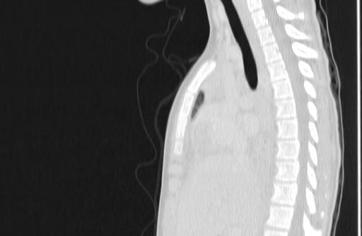 Bronchial mucoepidermoid carcinoma (Radiopaedia 57023-63895 Sagittal lung window 72).jpg