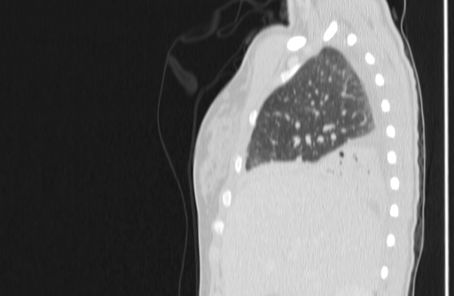 Bronchial mucoepidermoid carcinoma (Radiopaedia 57023-63895 Sagittal lung window 9).jpg