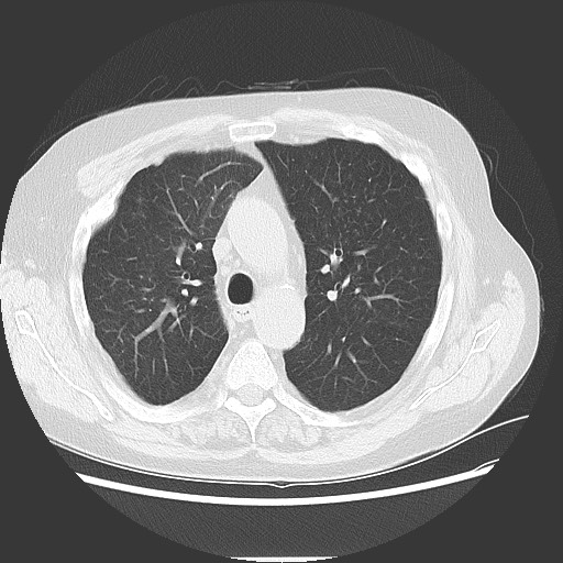 Bronchial stenosis - lung transplant (Radiopaedia 73133-83848 Axial lung window 23).jpg