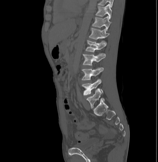 Bronchiectasis in Crohn disease (Radiopaedia 60311-67977 Sagittal bone window 147).jpg