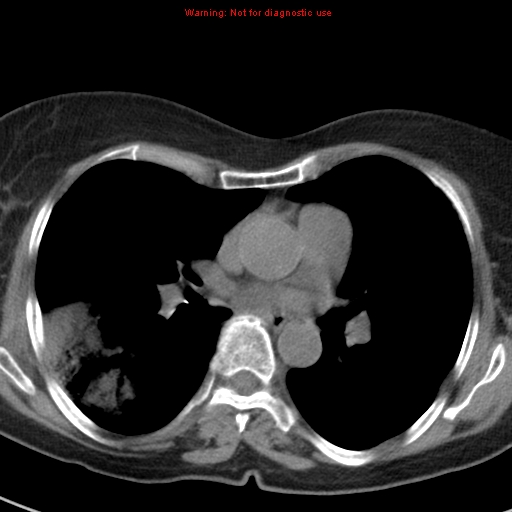 File:Bronchoalveolar carcinoma (BAC) (Radiopaedia 13436-13392 Axial non-contrast 27).jpg