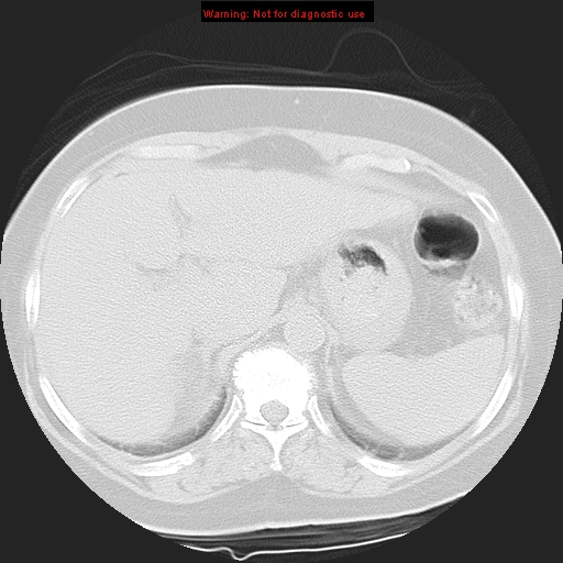 Bronchoalveolar carcinoma (Radiopaedia 13224-13233 Axial lung window 44).jpg