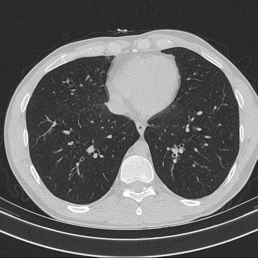 Bronchocele (Radiopaedia 60676-68429 Axial lung window 51).jpg