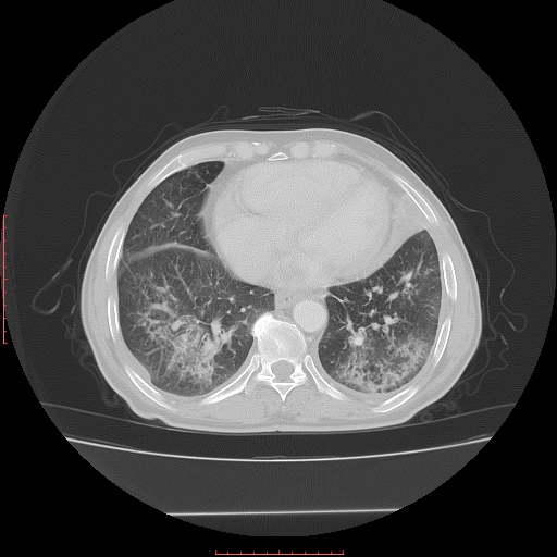 File:Bronchogenic carcinoma with left atrial large deposit - T4N3M1a (Radiopaedia 42316-45428 Axial lung window 21).jpg