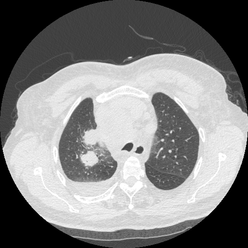 Bronchogenic carcinoma with metastatic lymphadenopathy (Radiopaedia 37671-39569 Axial lung window 15).jpg