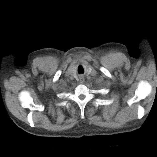 Bronchogenic carcinoma with metastatic lymphadenopathy (Radiopaedia 37671-39569 Axial non-contrast 3).jpg