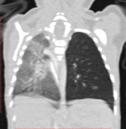 Bronchogenic cyst (Radiopaedia 78599-91409 Coronal lung window 155).jpg