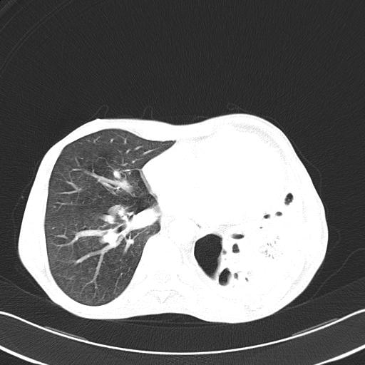 Bronchopleural fistula secondary to tuberculosis (Radiopaedia 20415-20322 Axial lung window 36).jpg