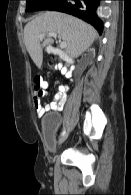 Brown tumors compressing the spinal cord (Radiopaedia 68442-77988 F 21).jpg
