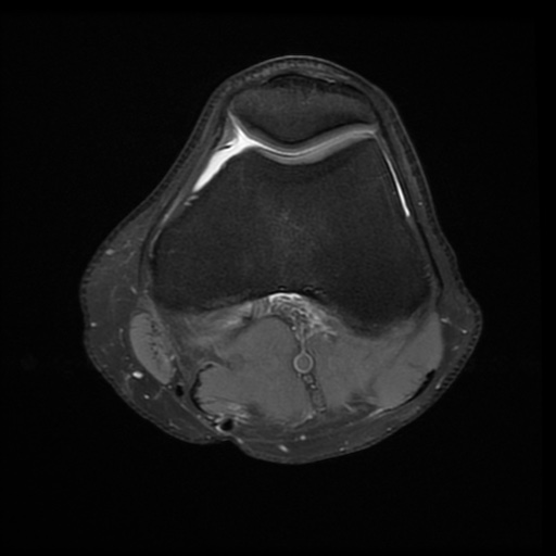 File:Bucket-handle meniscus tear (Radiopaedia 65700-74809 Axial PD fat sat 12).jpg