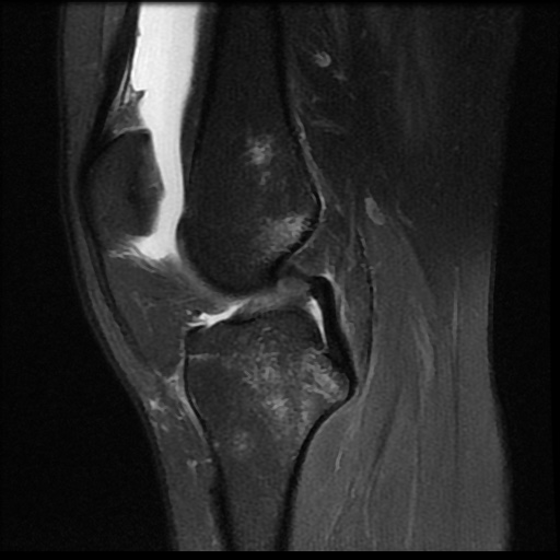 File:Bucket handle meniscus tear (Radiopaedia 56916-63751 Sagittal PD fat sat 11).jpg