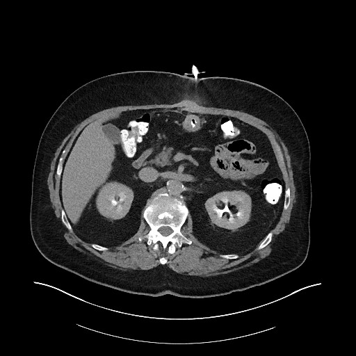 File:Buried bumper syndrome - gastrostomy tube (Radiopaedia 63843-72575 Axial Inject 6).jpg