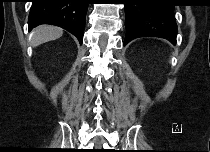 Buried bumper syndrome - gastrostomy tube (Radiopaedia 63843-72577 Coronal Inject 114).jpg