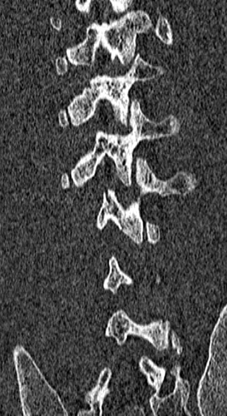 File:Burst fracture (Radiopaedia 53373-59357 Coronal bone window 63).jpg