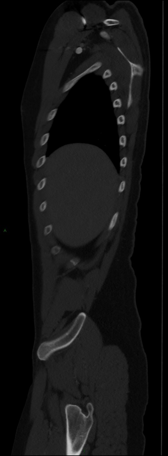 Burst fracture (Radiopaedia 83168-97542 Sagittal bone window 31).jpg