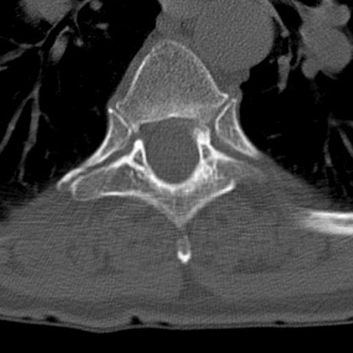 Butterfly vertebrae with kyphoscoliosis (Radiopaedia 14257-14133 Axial bone window 6).jpg