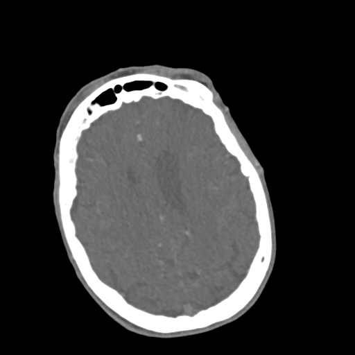 File:C2 fracture with vertebral artery dissection (Radiopaedia 37378-39200 A 269).png