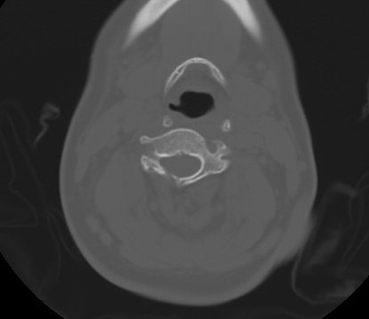 C7 laminar fracture and Klippel-Feil syndrome (Radiopaedia 86710-102850 Axial bone window 40).jpg