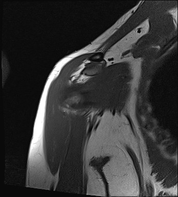 File:Calcific tendinitis of the infraspinatus tendon (Radiopaedia 87256-103537 Coronal T1 6).jpg