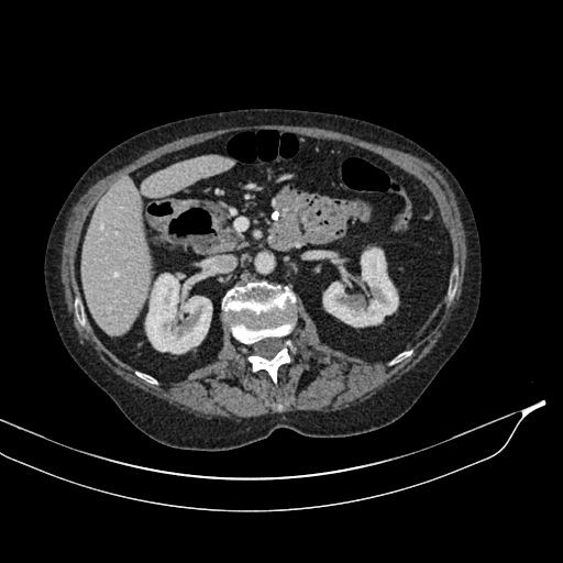 Calcified adrenal glands and Spigelian hernia (Radiopaedia 49741-54988 A 80).jpg