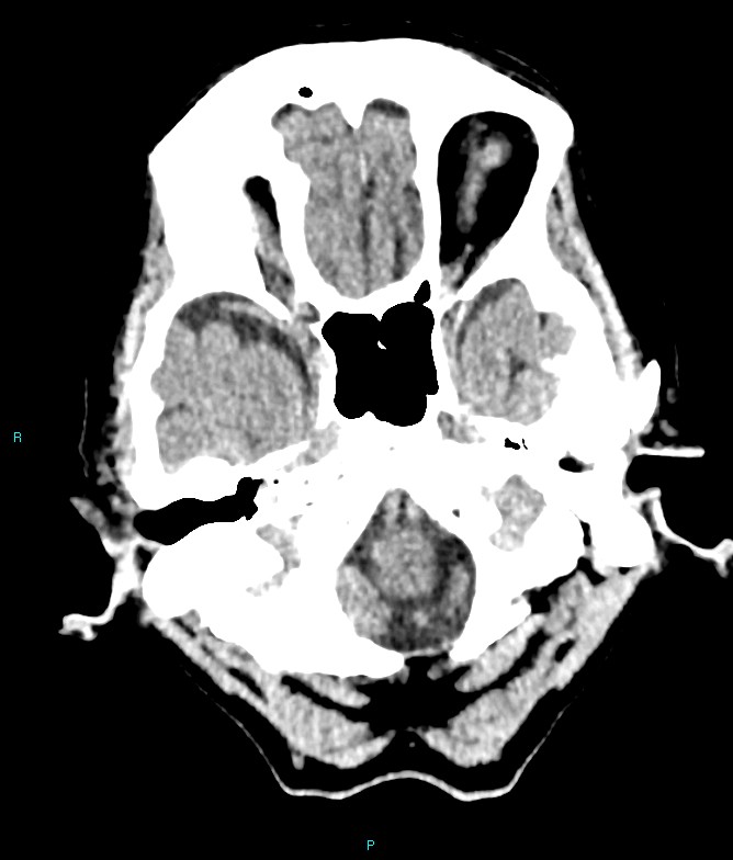 Calcified cerebral emboli from left ventricular thrombus (Radiopaedia 84420-99758 Axial non-contrast 77).jpg
