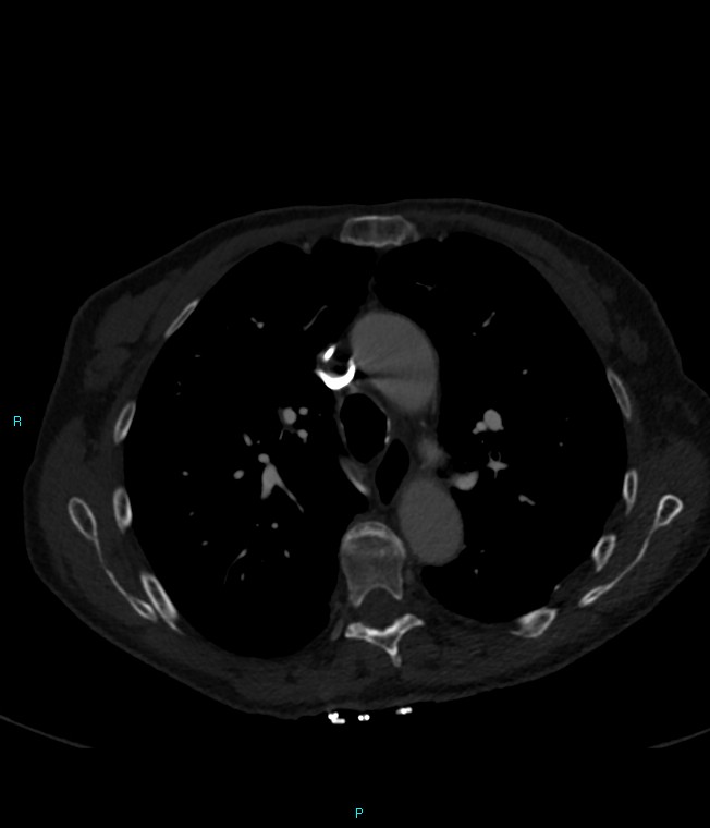 Calcified cerebral emboli from left ventricular thrombus (Radiopaedia 84420-99760 Axial bone window 28).jpg