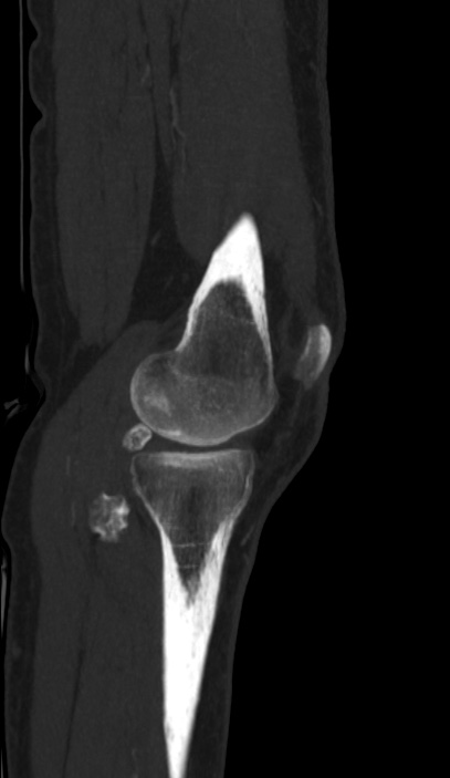 Calcified hematoma - popliteal fossa (Radiopaedia 63938-72763 D 5).jpg