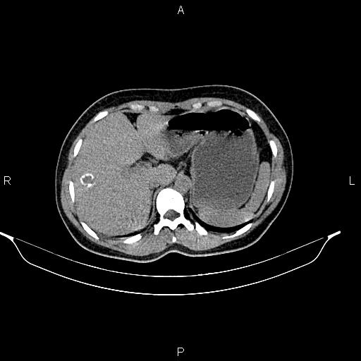 File:Calcified hepatic hydatid cyst (Radiopaedia 84672-100095 Axial non-contrast 25).jpg