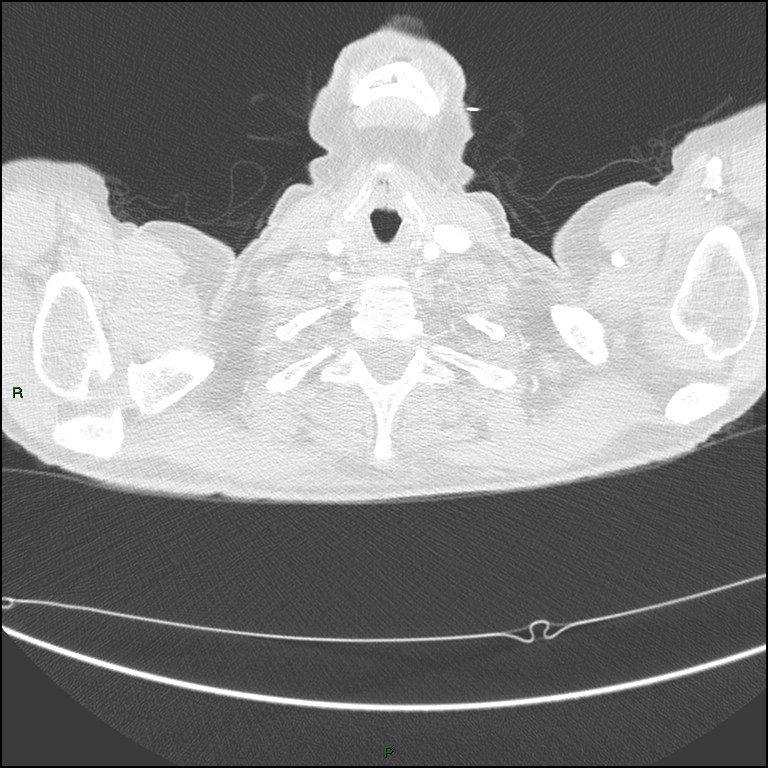 Cannonball metastases (Radiopaedia 82110-96150 Axial lung window 13).jpg