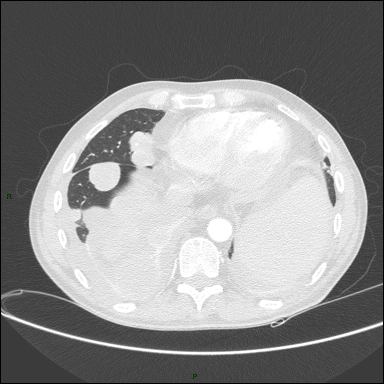 Cannonball metastases (Radiopaedia 82110-96150 Axial lung window 148).jpg