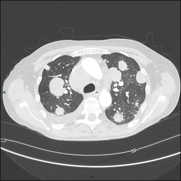 Cannonball metastases (Radiopaedia 82110-96150 Axial lung window 71).jpg