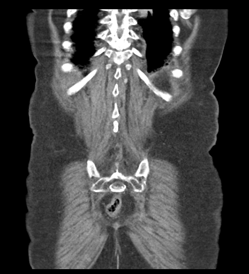 File:Cannonball metastases from endometrial cancer (Radiopaedia 42003-45031 F 55).png