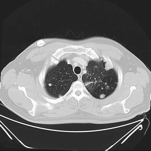 File:Cannonball pulmonary metastases (Radiopaedia 67684-77101 Axial lung window 4).jpg