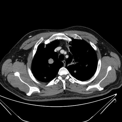 File:Cannonball pulmonary metastases (Radiopaedia 67684-77101 D 68).jpg