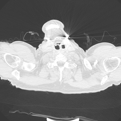 Caplan syndrome (Radiopaedia 56667-63530 Axial lung window 2).jpg