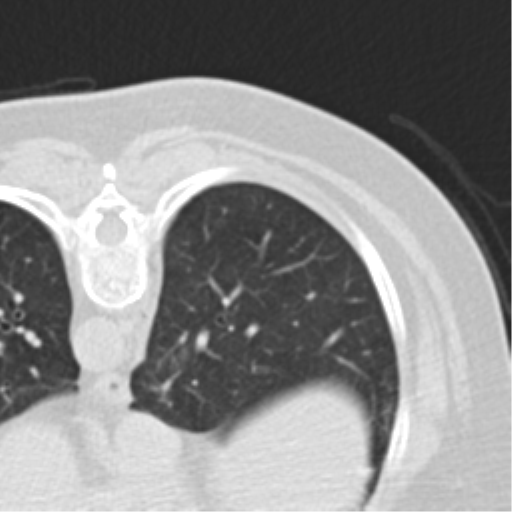 Carcinoid tumor - lung (Radiopaedia 44814-48644 Axial lung window 60).png