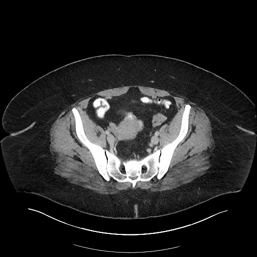 Carcinoid tumor - terminal ileum (Radiopaedia 60931-68739 A 105).jpg
