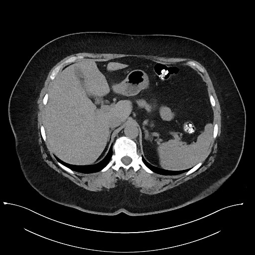 Carcinoid tumor - terminal ileum (Radiopaedia 60931-68740 Axial non-contrast 21).jpg