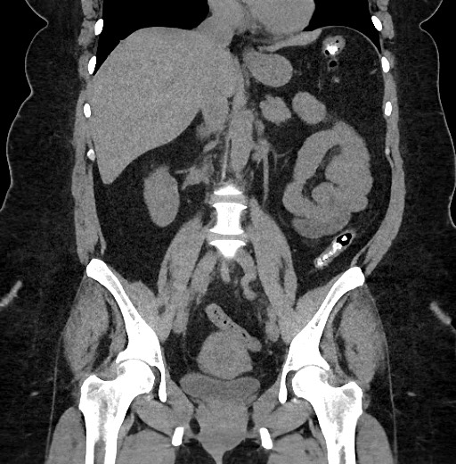 Carcinoid tumor - terminal ileum (Radiopaedia 60931-68740 Coronal non-contrast 56).jpg