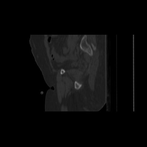 Carcinoma cervix- brachytherapy applicator (Radiopaedia 33135-34173 Sagittal bone window 44).jpg
