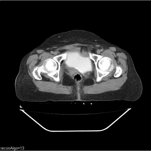 File:Carcinoma cervix- recurrence (Radiopaedia 34702-36137 B 88).jpg