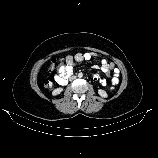 File:Carcinoma of uterine cervix (Radiopaedia 85861-101700 A 49).jpg