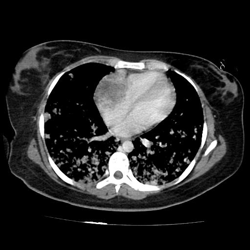 File:Cardiac angiosarcoma (Radiopaedia 66010-75181 B 108).jpg